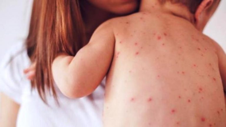 Όσα πρέπει να ξέρετε για την επιδημία της ιλαράς