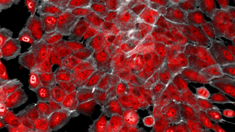 Ερευνητές ανακάλυψαν «διακόπτη» που μετατρέπει σε υγιή τα καρκινικά κύτταρα