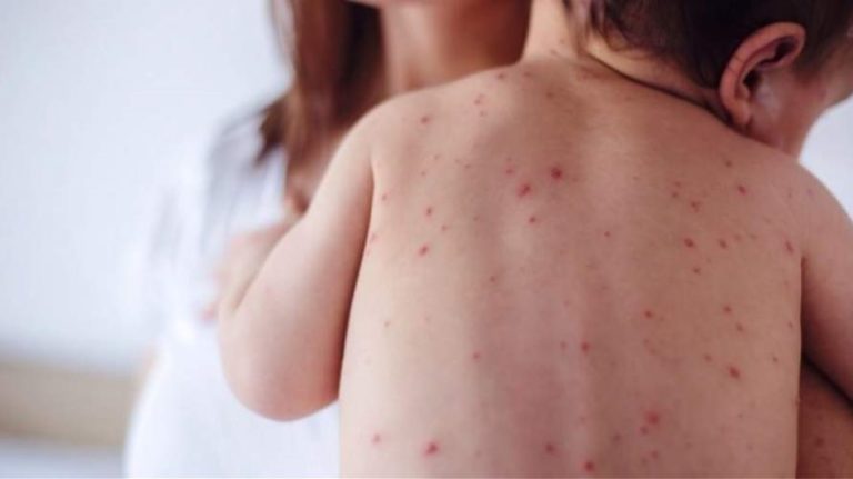 Επιστρέφει η ιλαρά στον δυτικό κόσμο – 4η η Ελλάδα