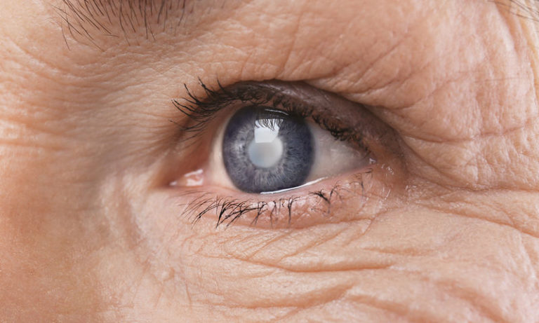Φως στο γλαύκωμα ρίχνουν οι επιστήμονες