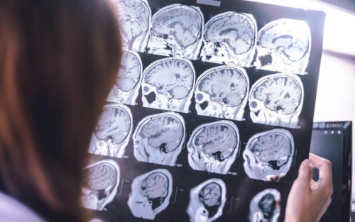 Τα κύτταρα «ζόμπι» στη μάχη κατά του Αλτσχάιμερ