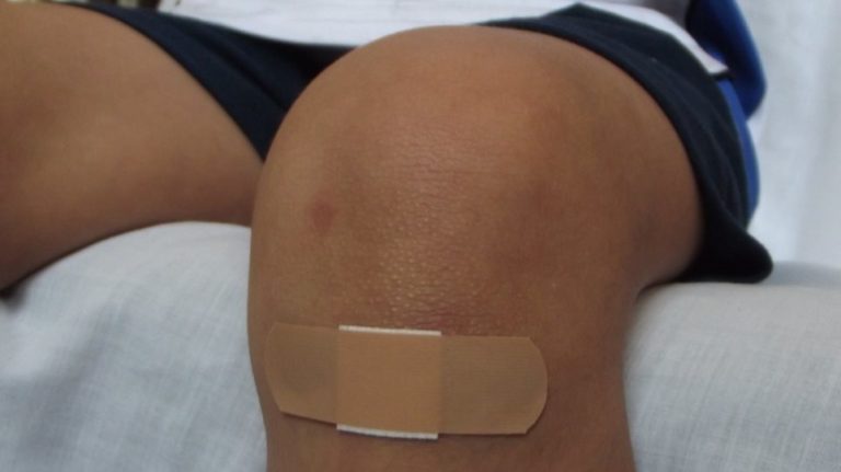 Επιστήμονες βρήκαν τρόπο να μετατρέπουν ανοιχτά τραύματα απευθείας σε νέο υγιές δέρμα