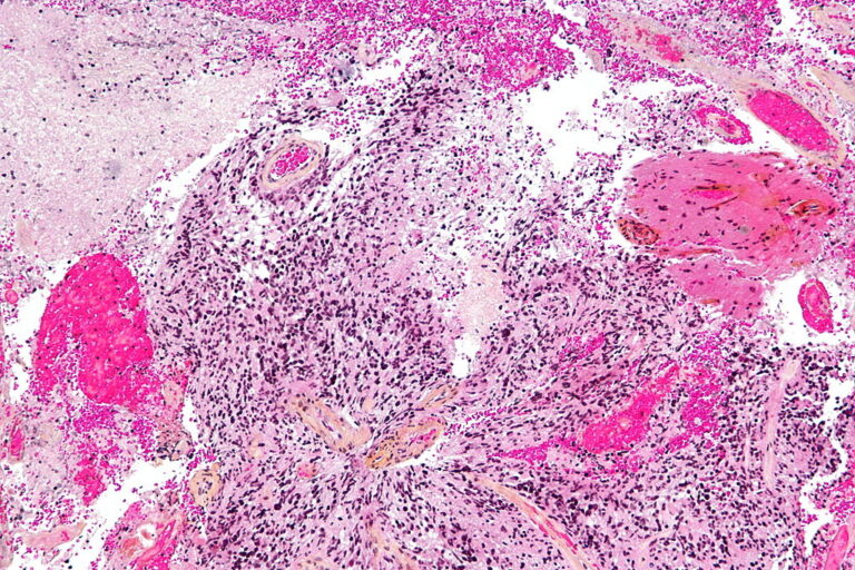 Εμβόλιο παρατείνει τη ζωή των ασθενών με επιθετικό καρκίνο του εγκεφάλου