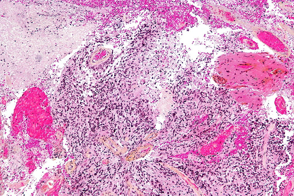 Εμβόλιο παρατείνει τη ζωή των ασθενών με επιθετικό καρκίνο του εγκεφάλου