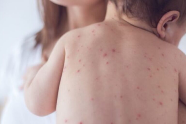 Ιλαρά: Αύξηση 79% των κρουσμάτων σύμφωνα με τον ΠΟΥ