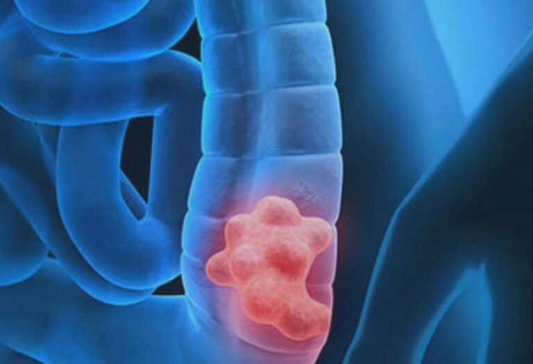 Καρκίνος παγκρέατος: Αύξηση της επίπτωσής του σε άτομα νεαρής ηλικίας