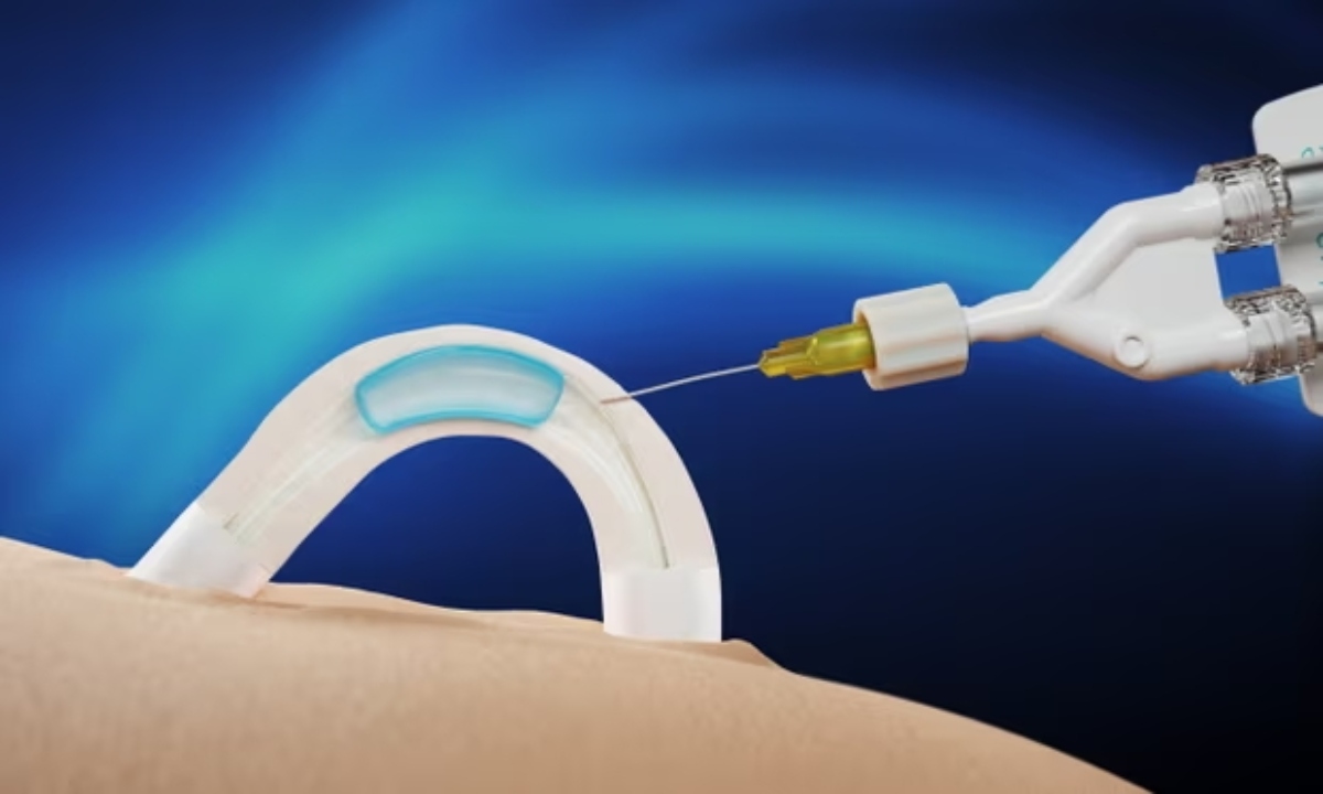 Adam: Το ανδρικό αντισυλληπτικό εμφύτευμα που διαρκεί δύο χρόνια