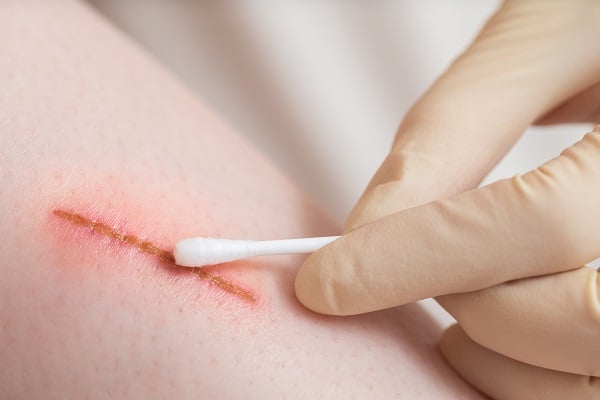 Οι πληγές των ανθρώπων επουλώνονται τρεις φορές πιο αργά σε σχέση με άλλα πρωτεύοντα θηλαστικά