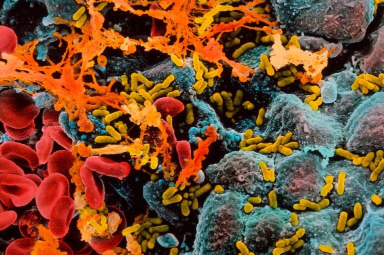 Κυστίτιδα, πνευμονία, τερηδόνα: πώς οι λοιμώξεις συνδέονται με άνοια