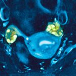 Το PCOS καθυστερεί την περιεμμηνόπαυση και παρατείνει τη γονιμότητα