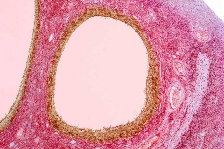 Η PCOS μετονομάζεται επίσημα σε PMOS