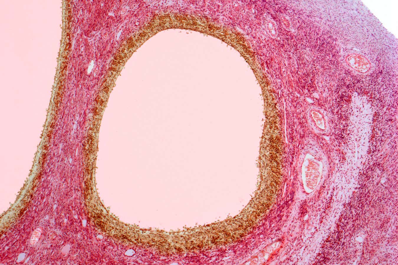 Η PCOS μετονομάζεται επίσημα σε PMOS