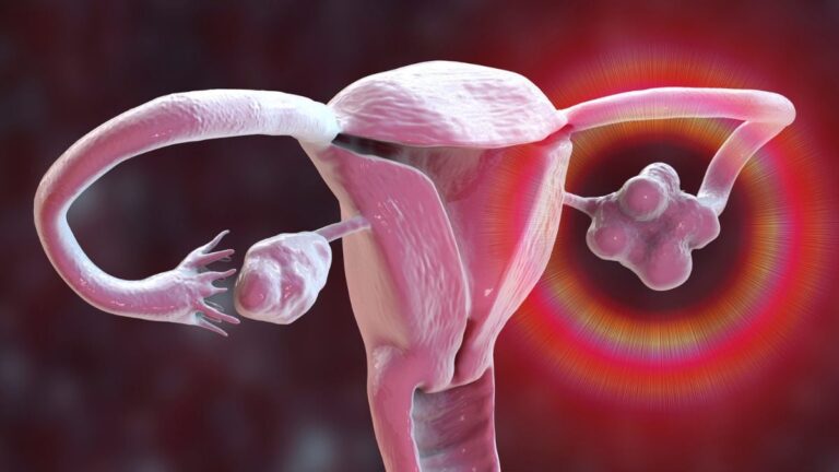 Επίσημη μετονομασία του PCOS μετά από δεκαετίες παραπληροφόρησης