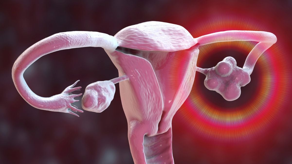 Επίσημη μετονομασία του PCOS μετά από δεκαετίες παραπληροφόρησης