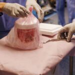 Μεταμοσχευμένο νεφρό χοίρου κράτησε άνδρα χωρίς αιμοκάθαρση για εννέα μήνες